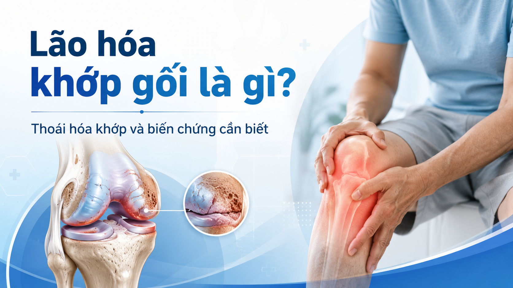Lão hóa khớp gối là gì? Thoái hóa khớp và biến chứng cần biết